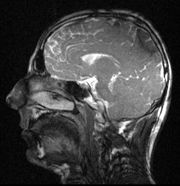 1st Linac-MR image of head